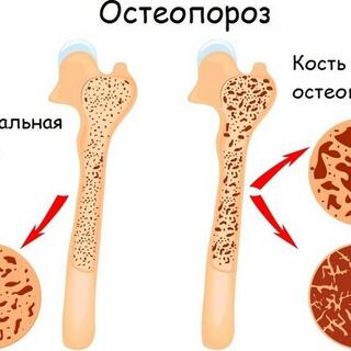 images/osteoporosis(1).jpg