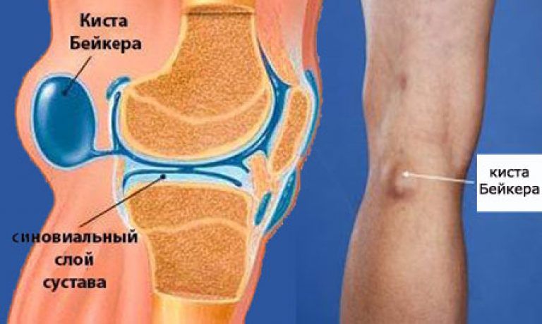 Боль под коленом сзади: причины, диагностика, лечение